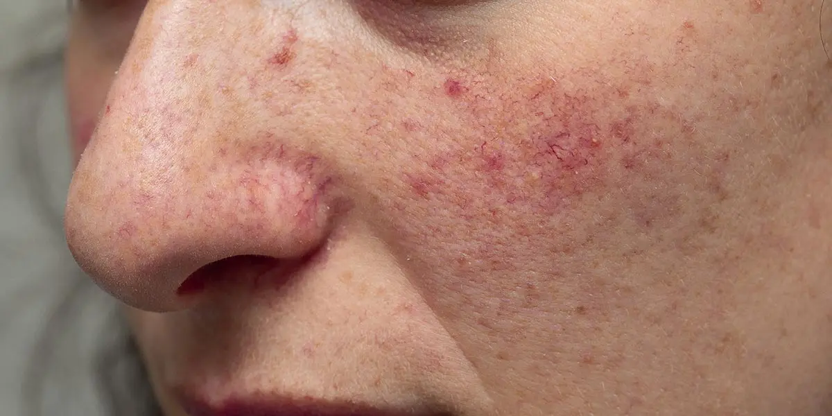 Rosacea behandling i middelfart ved Klinik Kronborg